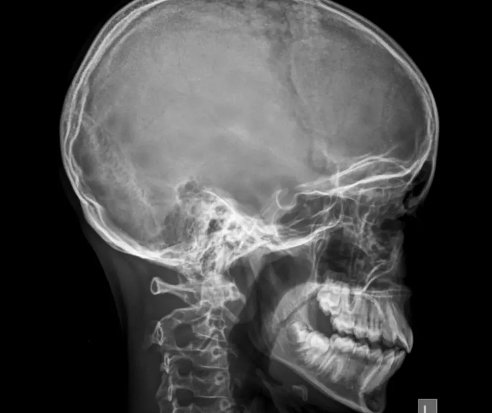 Skull Fracture